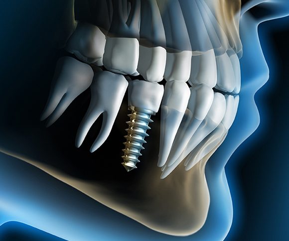 Implantologia