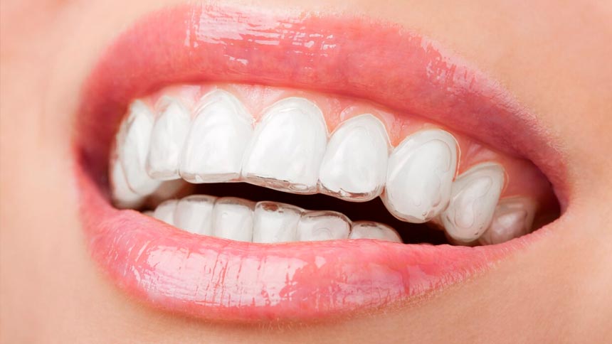 Ortodontia Descomplicada – Invisalign ®